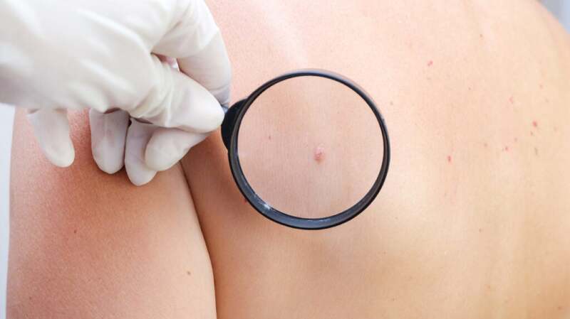 A medical image of desmoplastic melanoma.