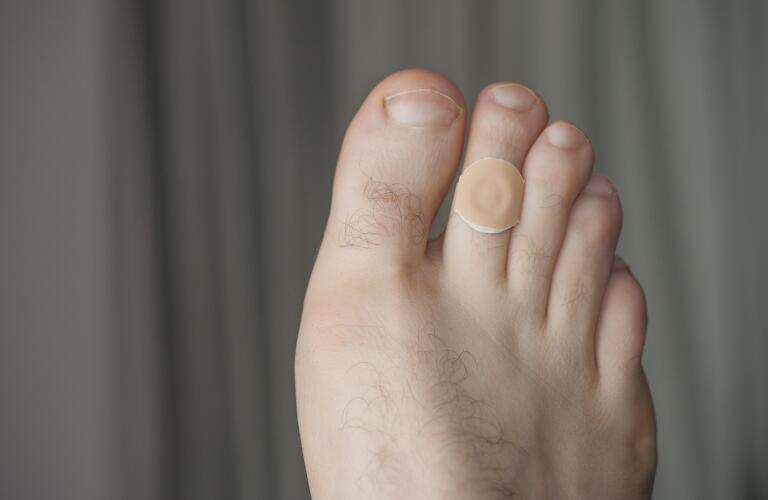 Plantar callus removal: how to get rid of calluses on feet