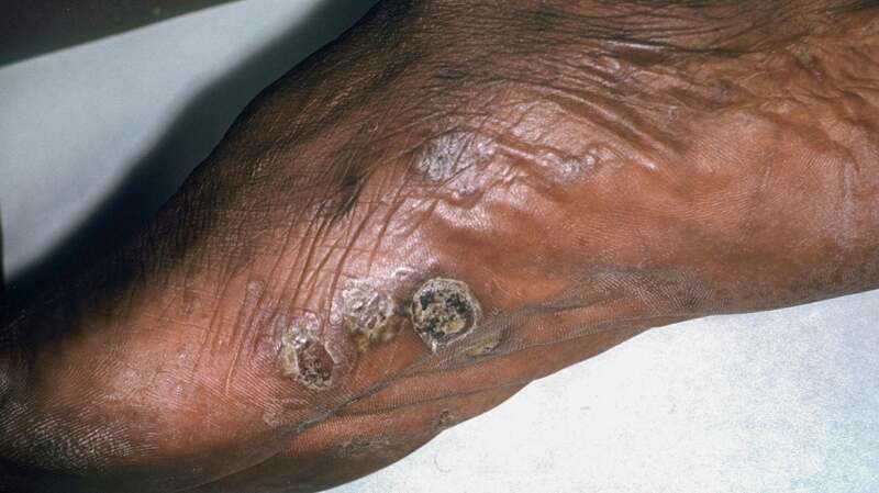 A medical image of dyshidrotic eczema.