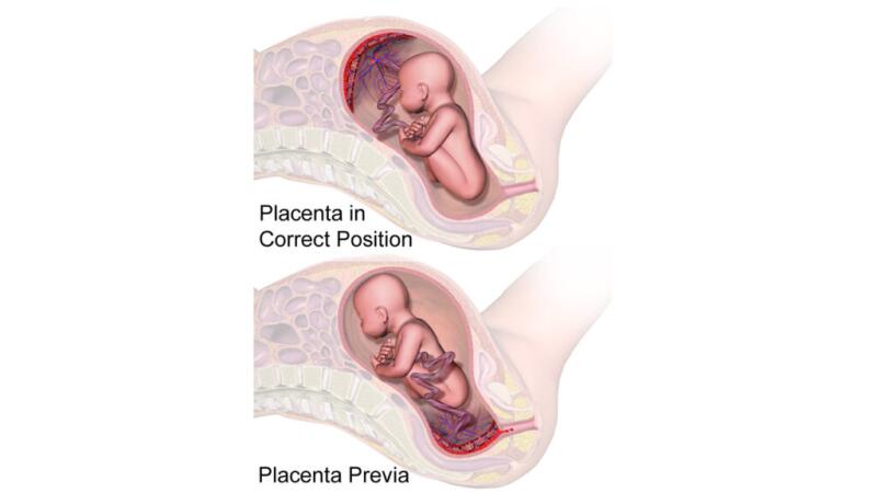 Medical illustration shows placenta previa vs placenta in the correct position