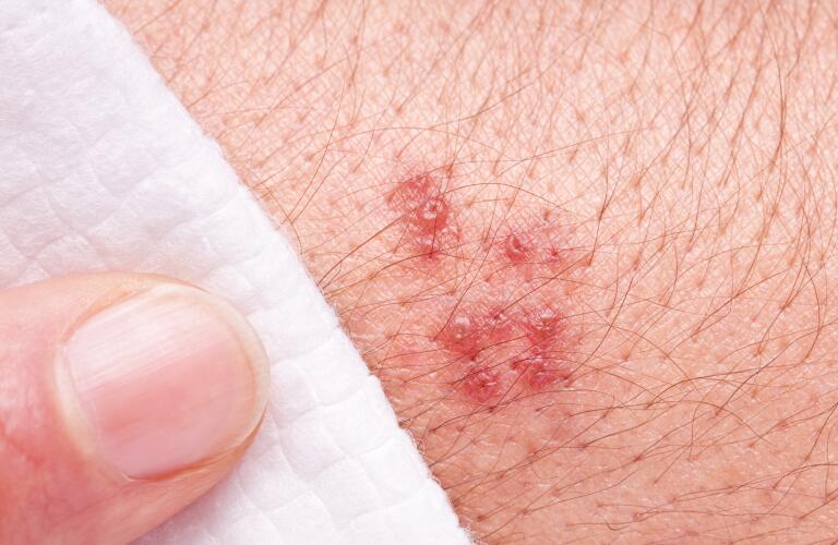 finger pointing to shingles rash on hand or arm