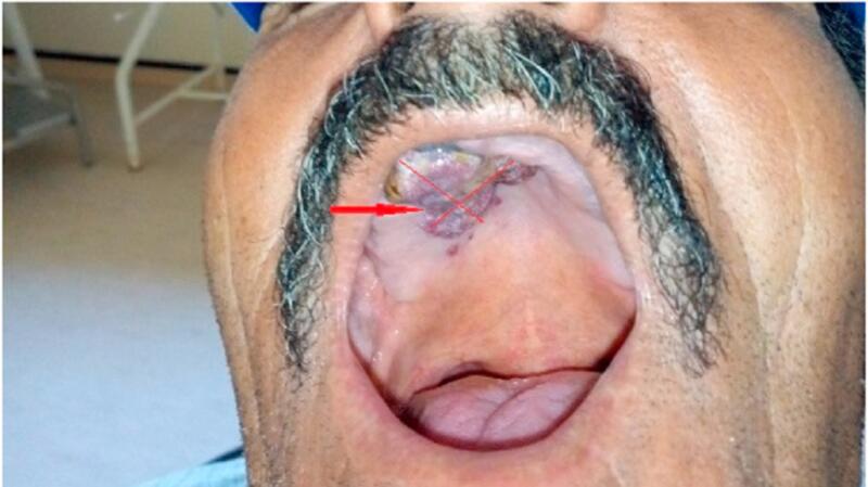 oral melanotic macule inside cheek Get Rid of Gingival Pigmentation with the help of Huffman Dentist TX