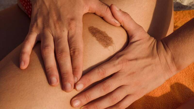A close-up of a large mole on someone's leg.