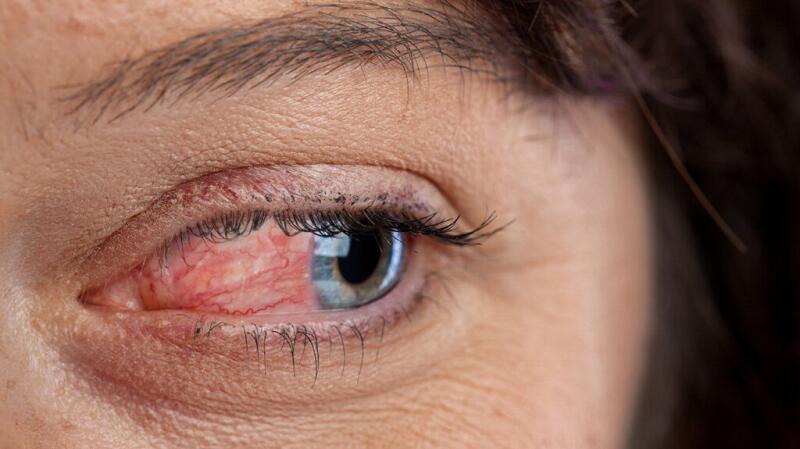 Close up of woman with ocular rosacea