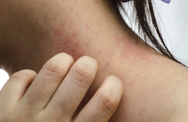 Are you Ignoring the Rashes Under Your Breasts