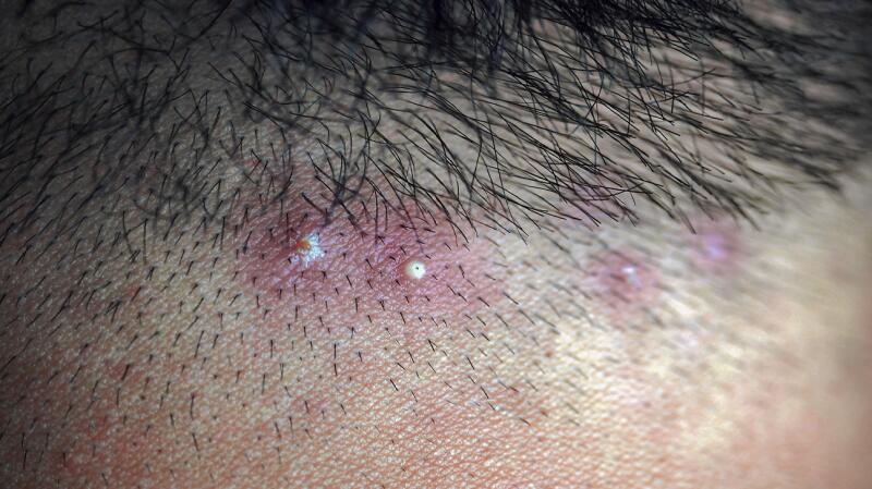 Scalp Folliculitis Signs Causes Treatment And More scalp-folliculitis-signs-causes-treatment-and-more