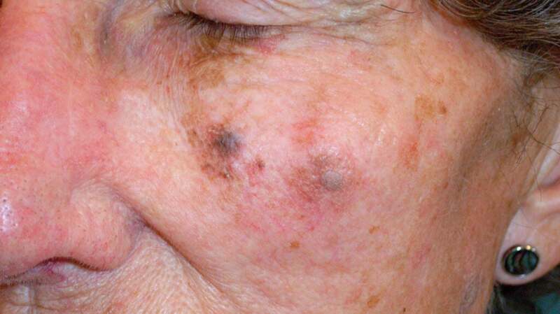 A medical image of lentigo maligna melanoma.