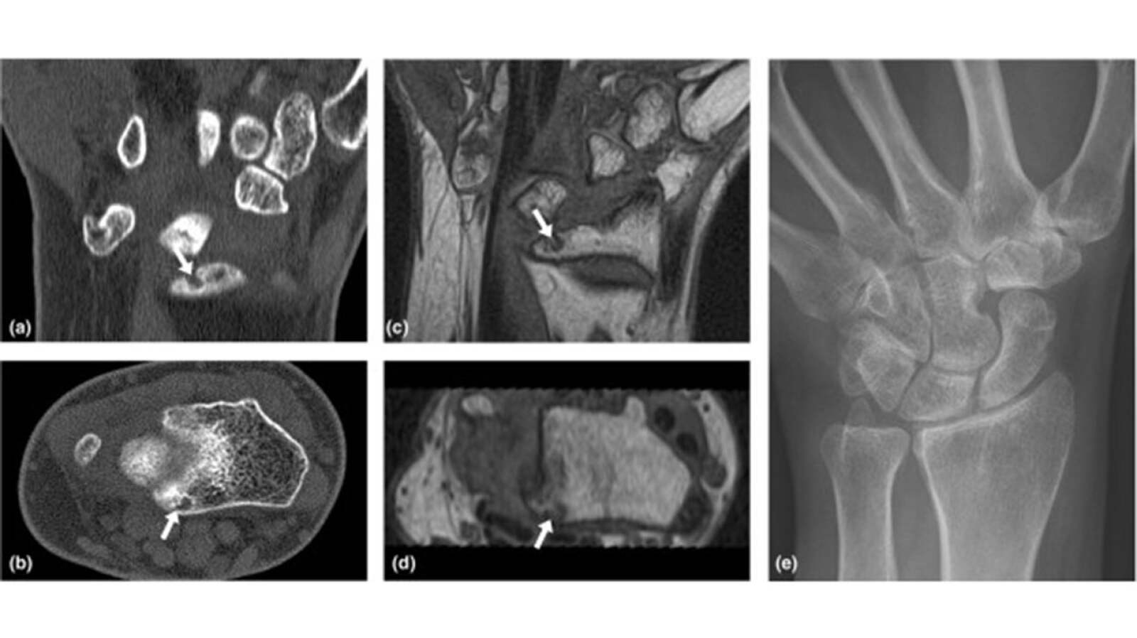 Wrist Arthritis Types, Symptoms, Treatments, and More