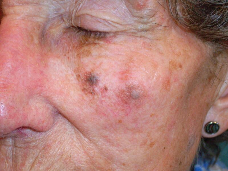Lentigo Maligna: Causes, Symptoms, and Treatments