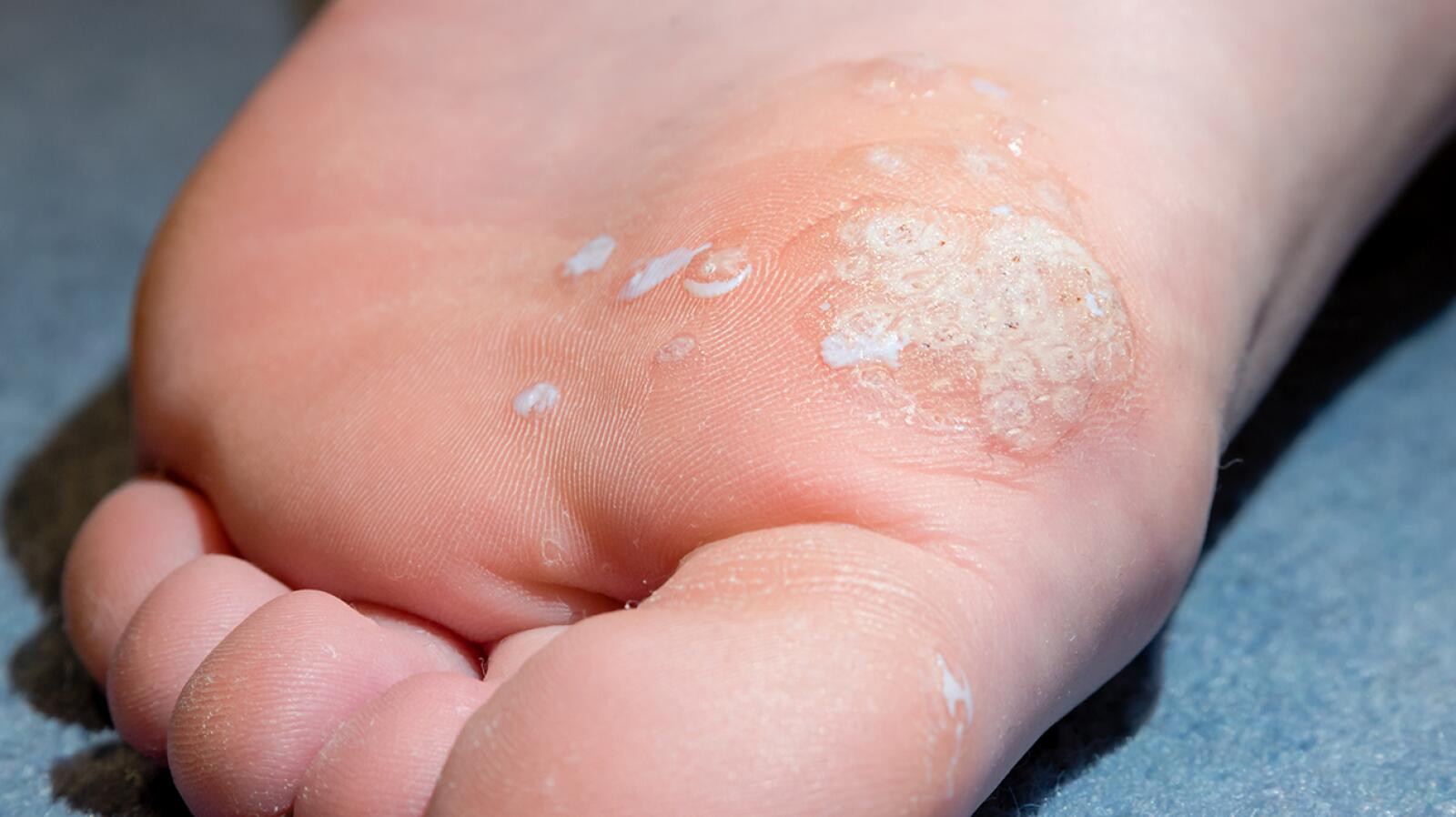 Mosaic Warts Symptoms, Causes, Treatments, and More