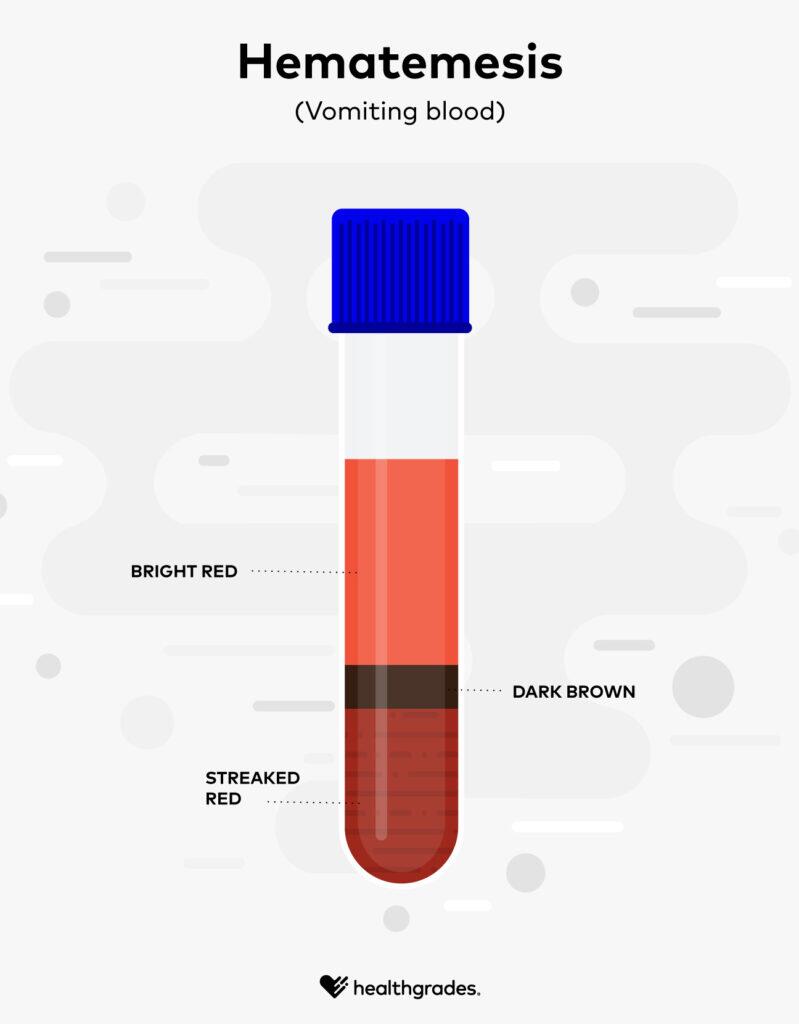 23871-hematemsis-body-1296x1660-1-799x1024.jpg