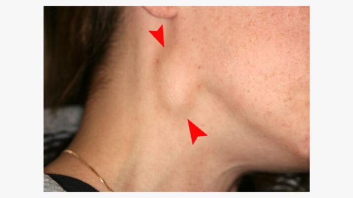 swollen lymph node in the neck, also called cervical lymphadenopathy