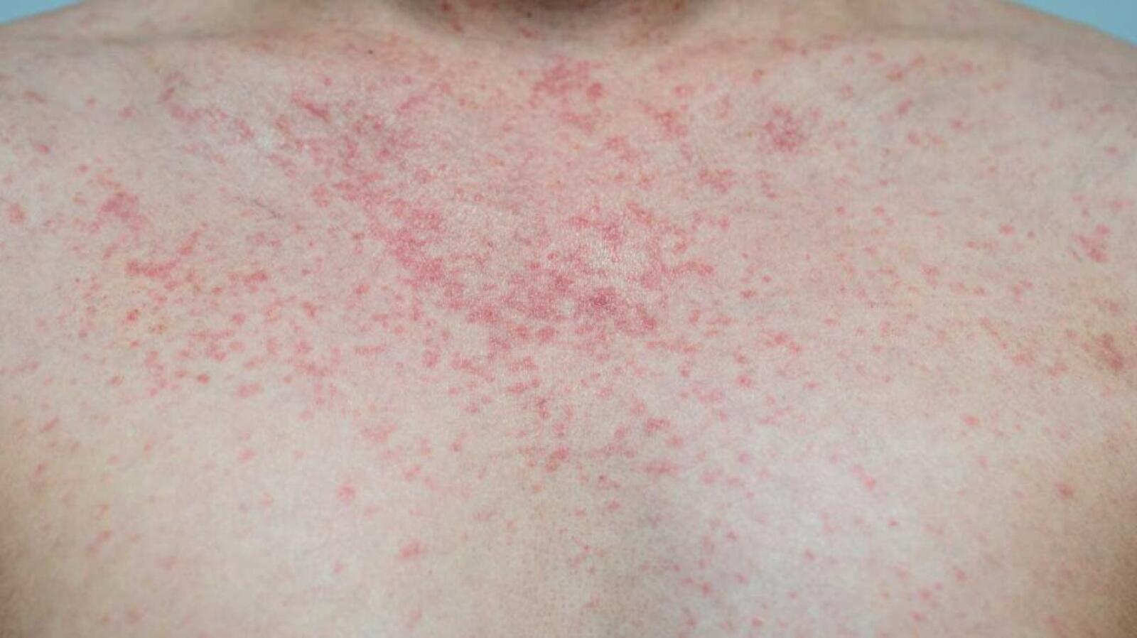 What Does an RSV Rash Look Like? Symptoms, Pictures, and Recovery