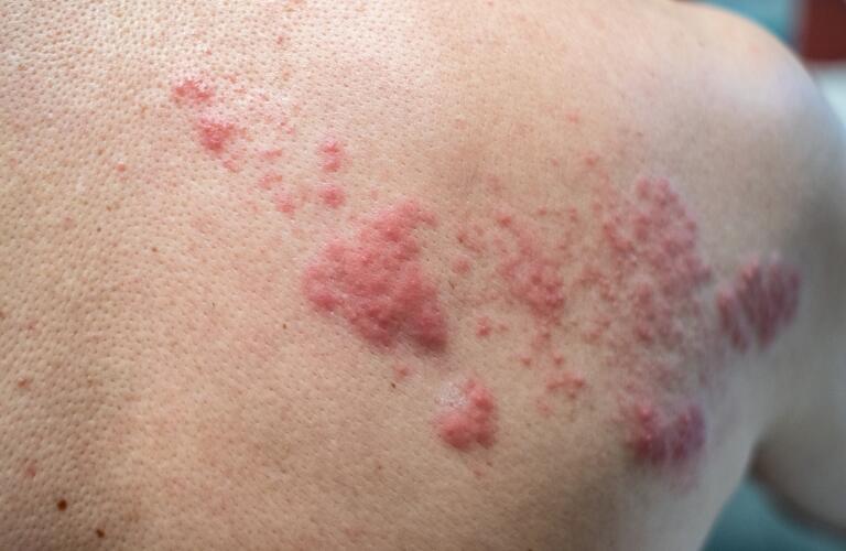 Close-up of shingles rash (herpes zoster) on shoulder