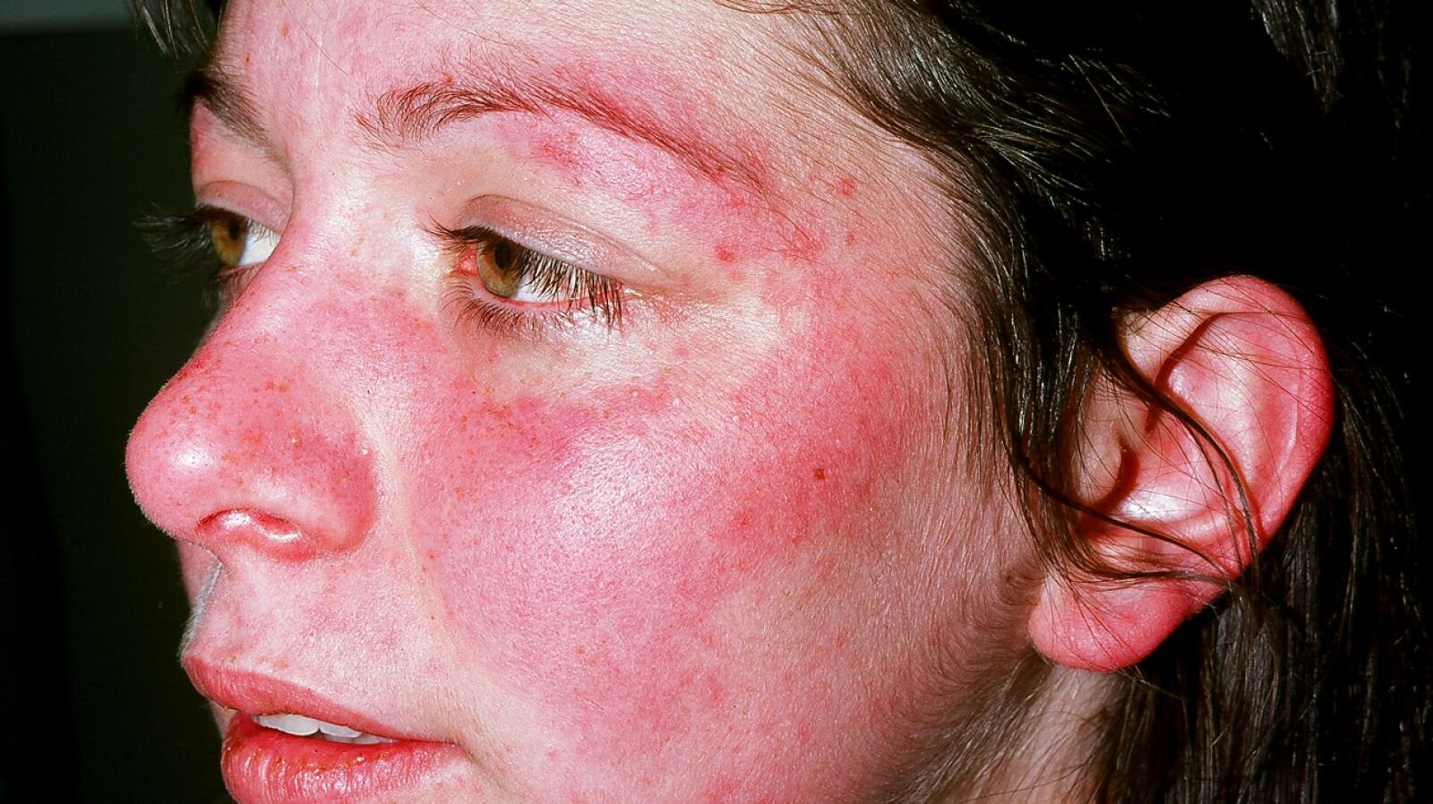 Butterfly Rash Causes Symptoms Treatments