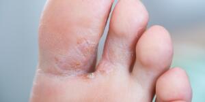 Common Rashes That Can Cause Foot Pain and Irritation - Walkrite Foot Clinic