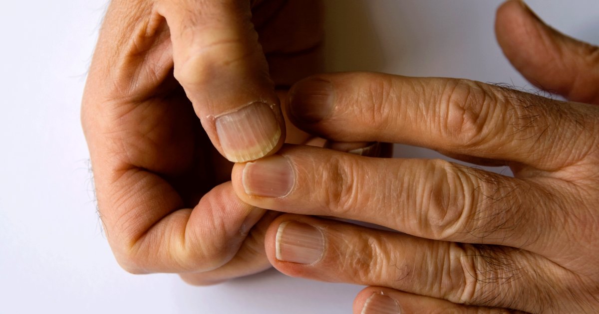Swollen Finger Swelling Fingers Symptoms Causes Treatments Diagnosis