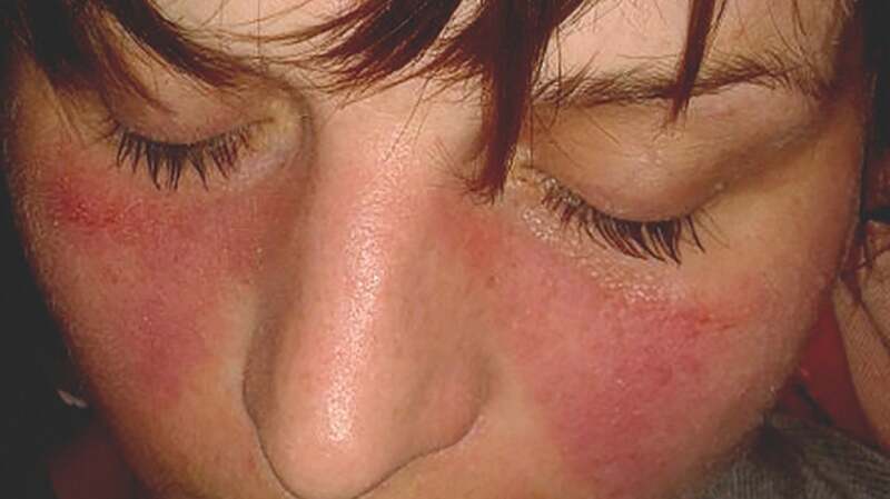 Lupus Rash Vs Rosacea Symptoms Causes Treatments 