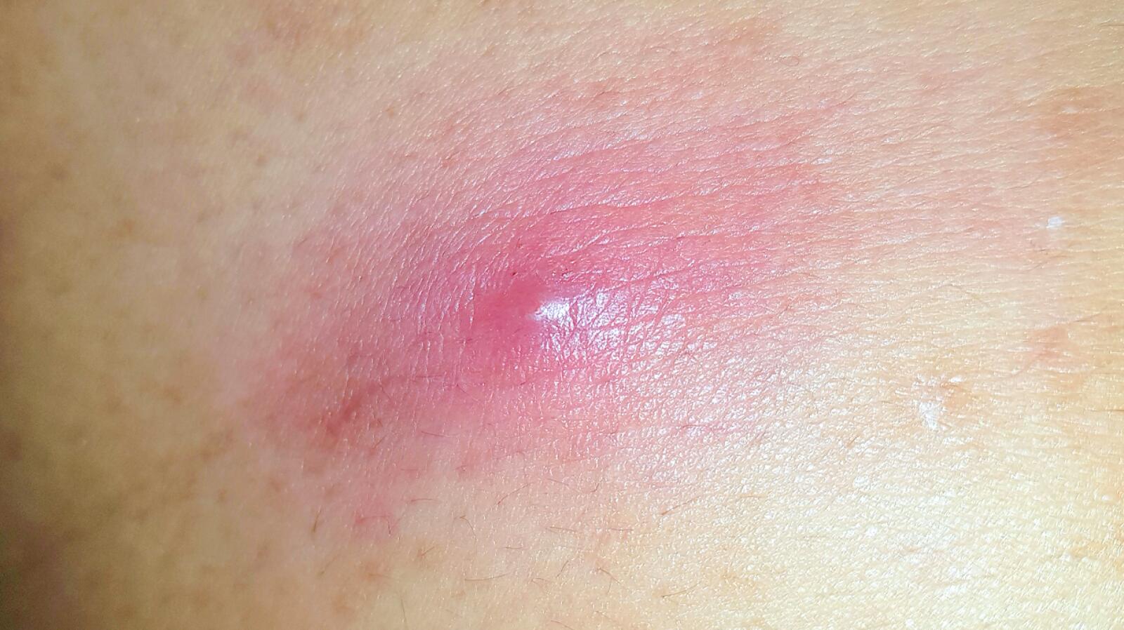 Boil vs Cyst: Symptoms Appearance Treatments and More