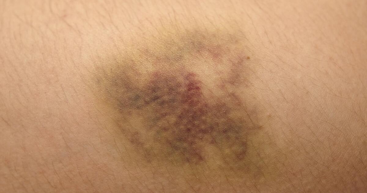 Bruising - Symptoms, Causes, Treatments