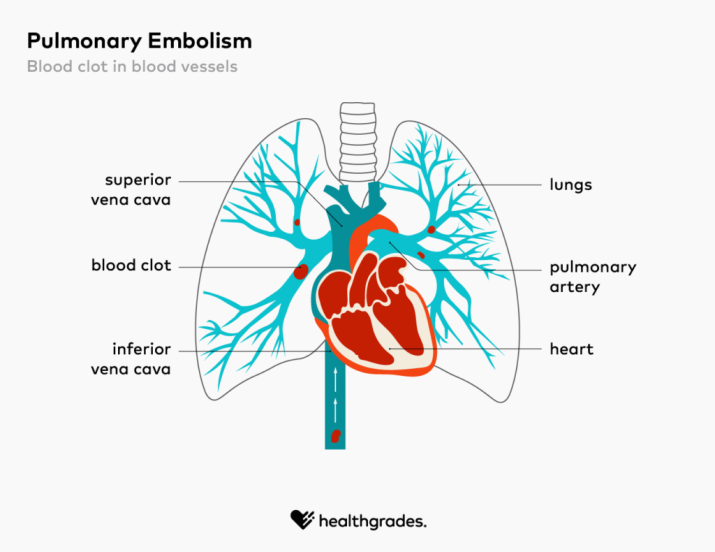 Illustration of pulmonary embolism