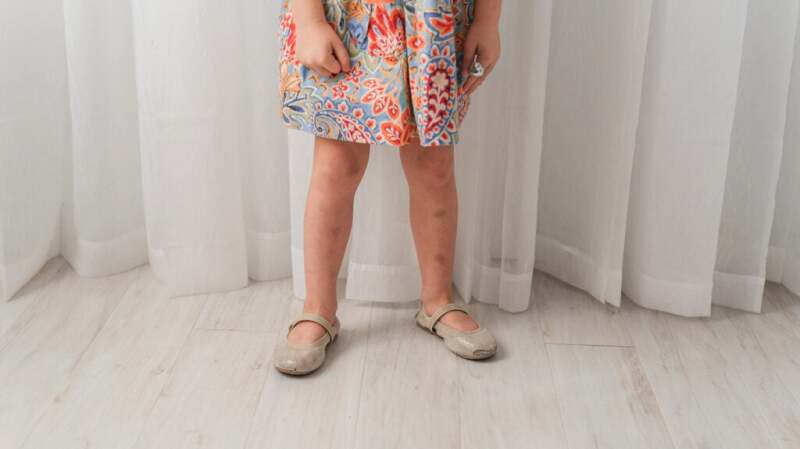 An older adult stands in a dress showing mild bruises on the lower legs.