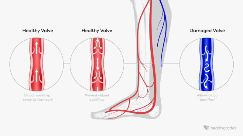 An illustration comparing the structure of healthy valves in the veins with damaged valves in the veins.