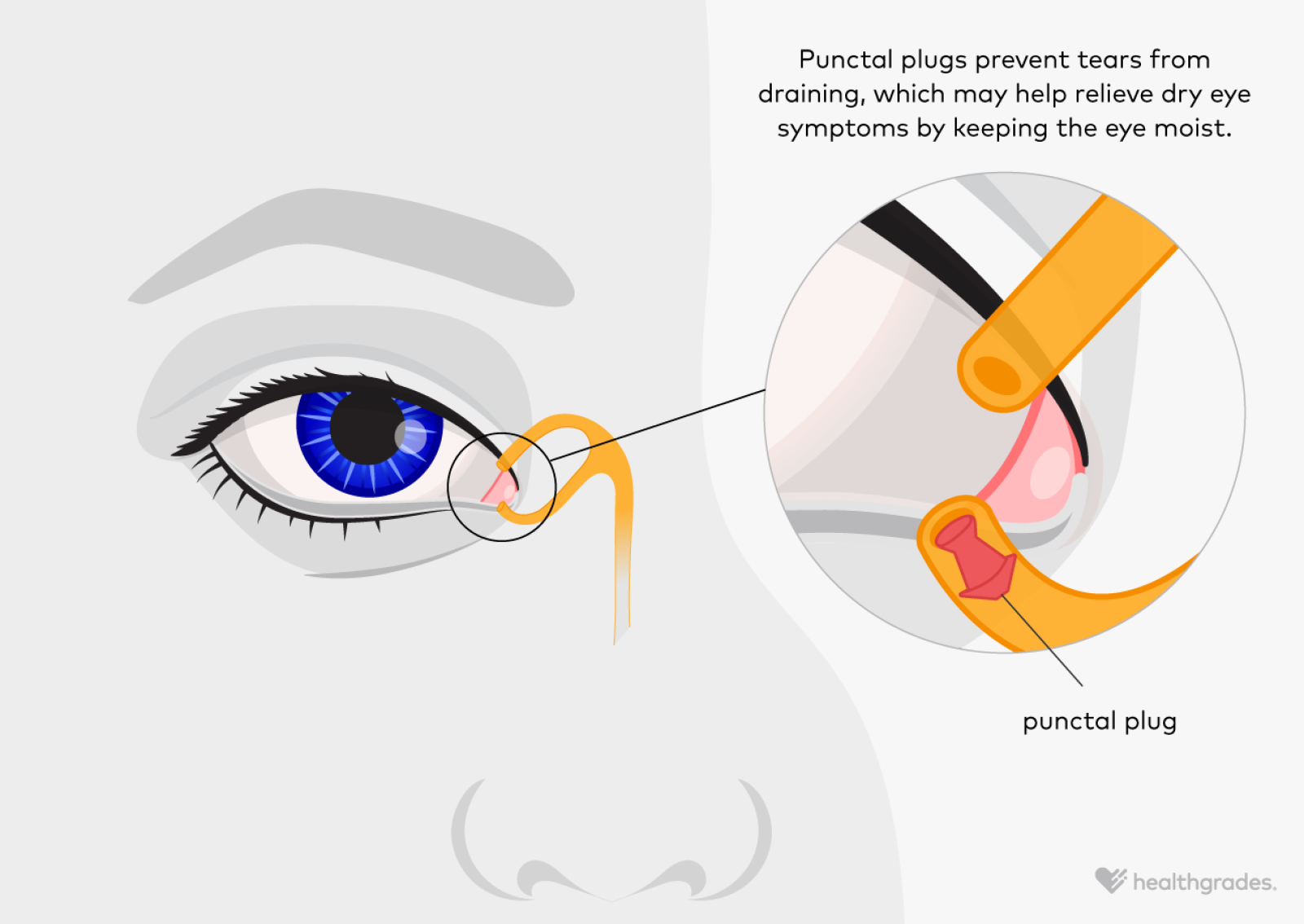 Punctum Numbers Punctal Plugs: Purpose, Procedure, and Removal