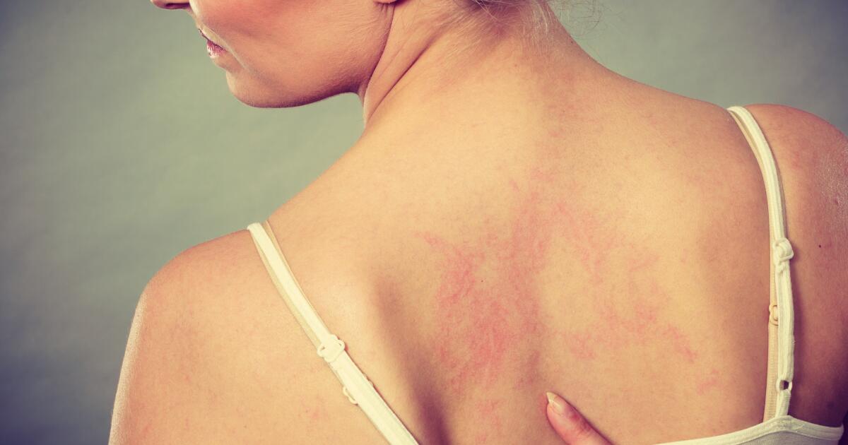 Christmas Tree Rash: Symptoms, Causes & Treatment | Pityriasis Rosea