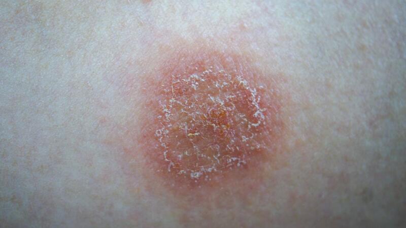 How to Care for Discoid Eczema: Symptoms, Triggers, Treatment