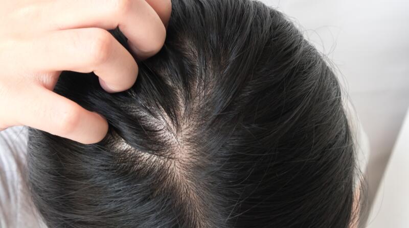 8 Things to Know About Dandruff Causes & Remedies