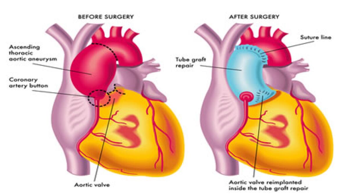 prognosis after thoracic aortic aneurysm surgery