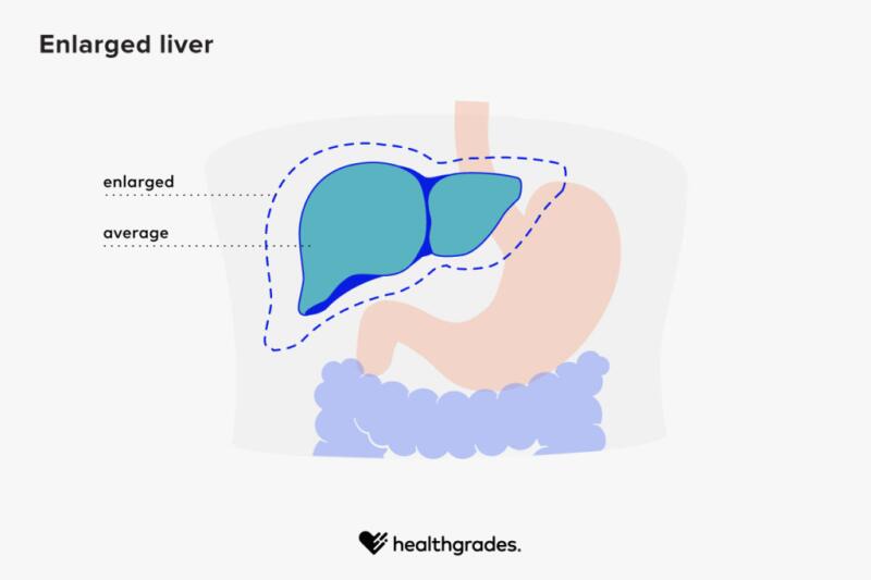 enlarged liver hepatitis