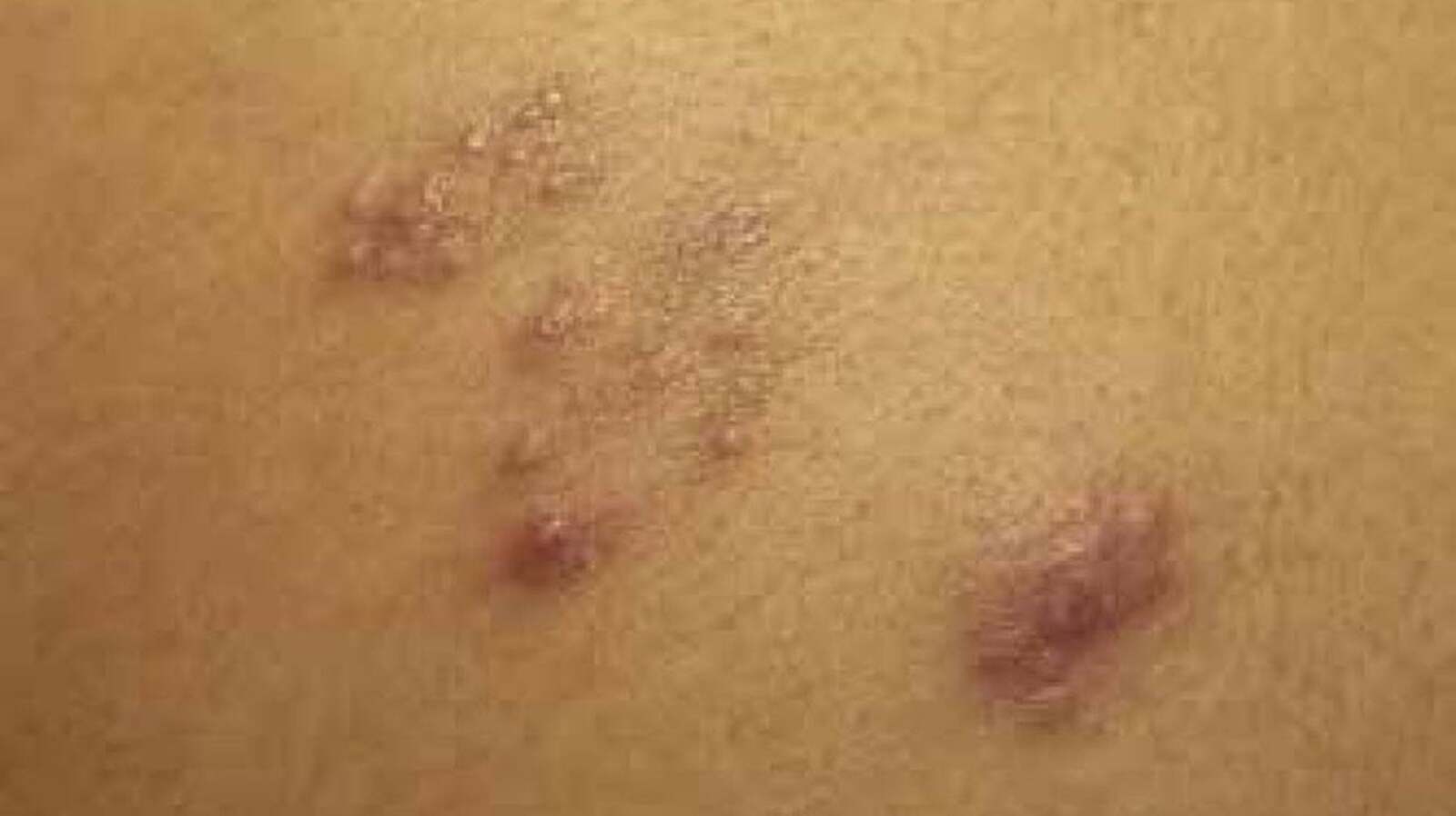 Crohn's Disease Rash Pictures, Causes, and Treatment