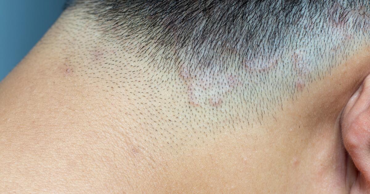 Psoriatic Arthritis Rash | Psoriatic Arthritis