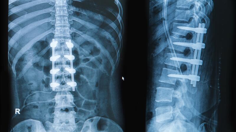 xray image of partially fused spine with screws