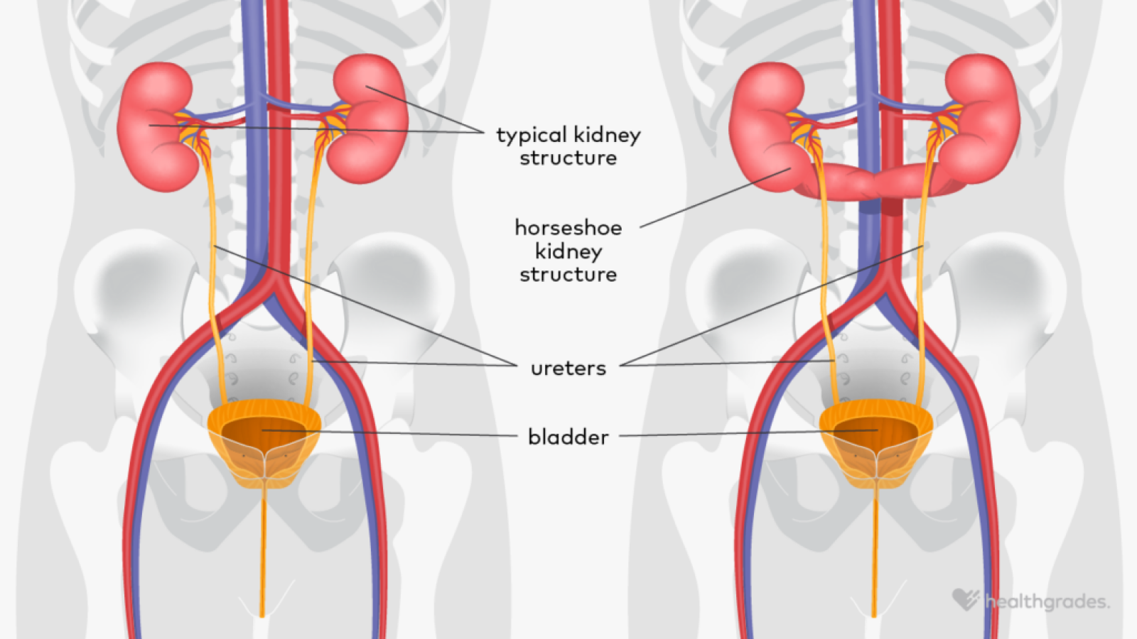 Horseshoe Kidney Symptoms Causes And Treatment Horseshoe Kidney Symptoms Causes And Treatment