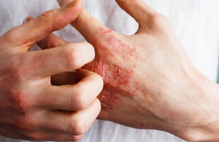 Lebrikizumab Effective for Adults, Teens With Atopic Dermatitis