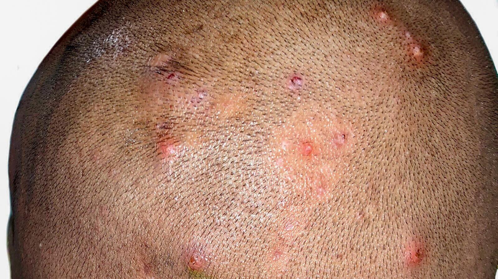 Scalp Folliculitis Signs Causes Treatment And More Scalp Folliculitis Signs Causes Treatment And More