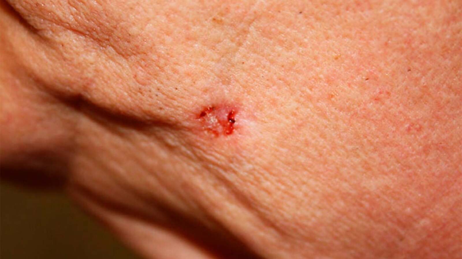 Images Of Basal Cell Carcinoma Pictures Diagnosis And More images-of-basal-cell-carcinoma-pictures-diagnosis-and-more