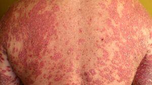 Erythrodermic psoriasis can appear as an itchy, peeling rash on the body.