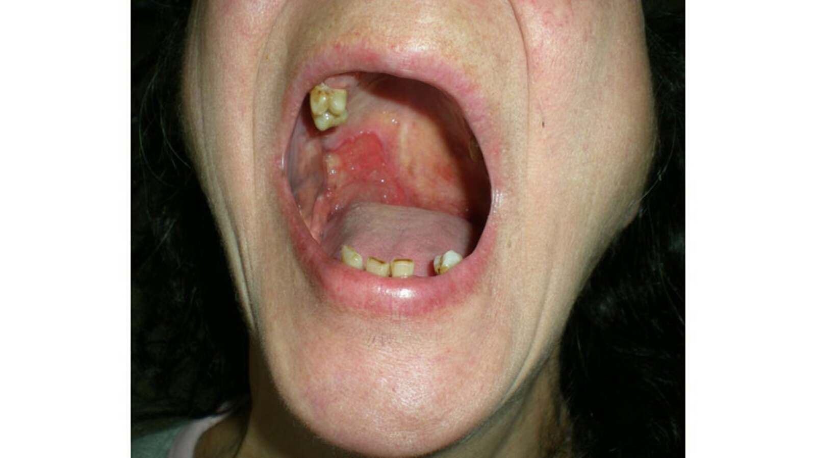 Oral Squamous Cell Carcinoma: Mouth Cancer Symptoms and More