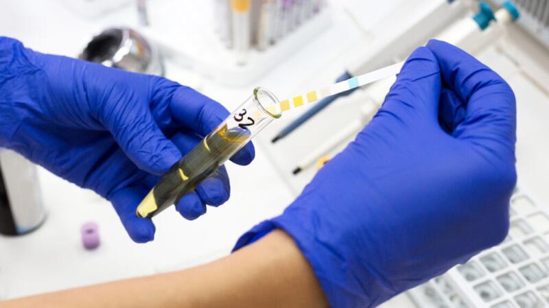 A person is testing a urine sample.