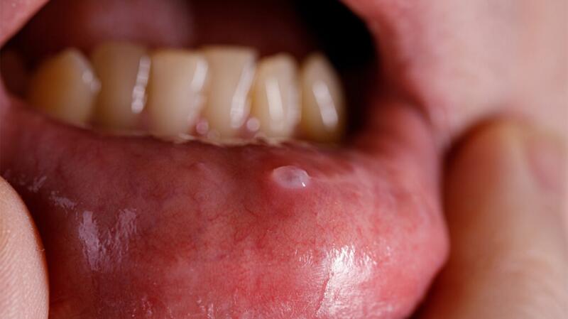 oral-mucocele-resized-1024x575.jpg