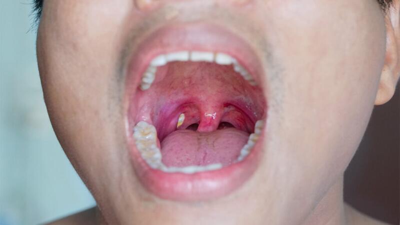 Medical image of someone with open mouth showing tonsil stones
