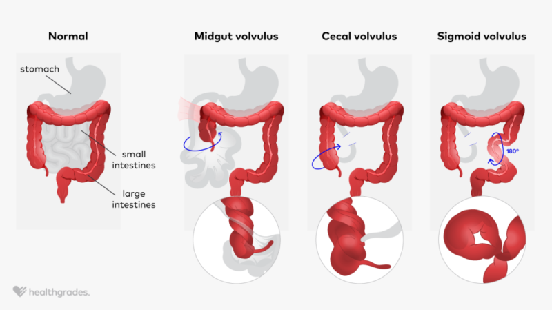 Volvulus: Definition, Causes, and Treatment