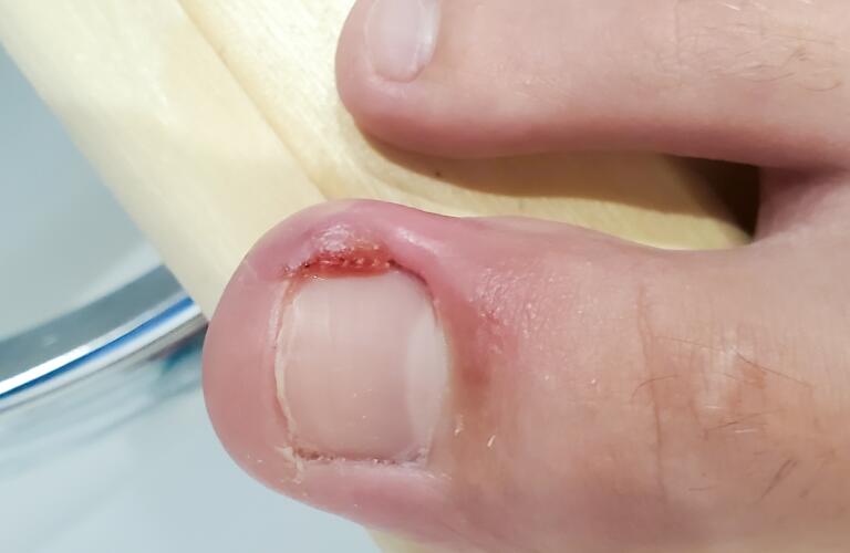 inflamed big toe with an ingrown nail and pus