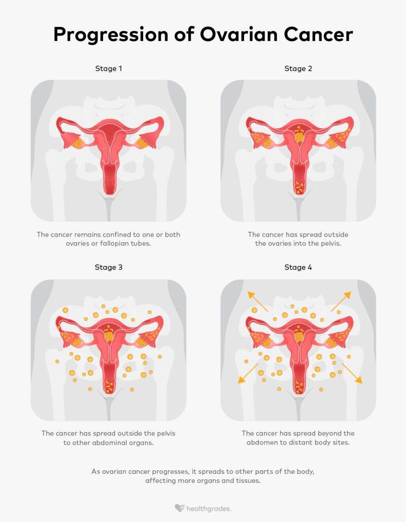 Stages of Ovarian Cancer Symptoms, Treatments, and Outlook