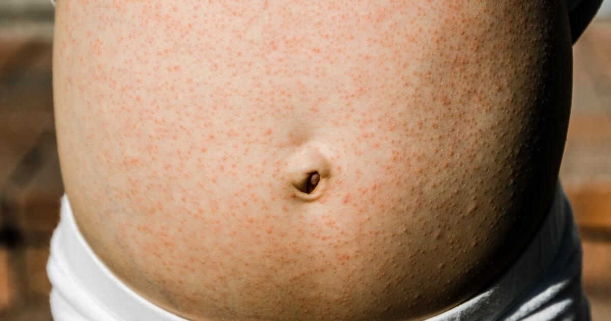 Stomach Rash: Symptoms, Causes & Treatment