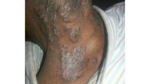 A medical image of plaque psoriasis.